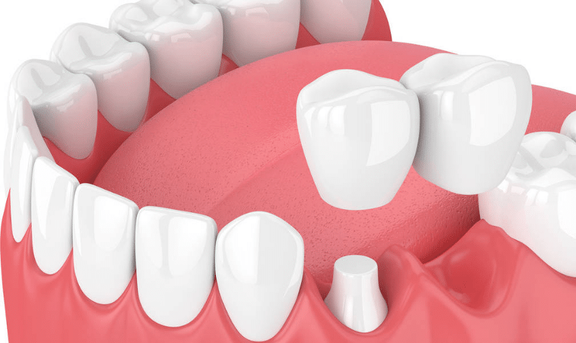 What is the purpose of a dental bridge?