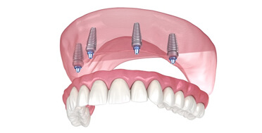 Dental implants illustration showing three titanium posts anchored in pink gum tissue supporting artificial teeth.