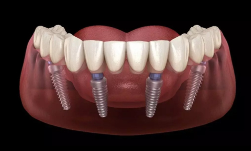 Dental implant illustration showing four titanium posts anchored in jawbone with ceramic crowns attached.