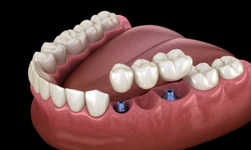 Dental implant model showing prosthetic teeth placement on lower jaw with implant posts visible.