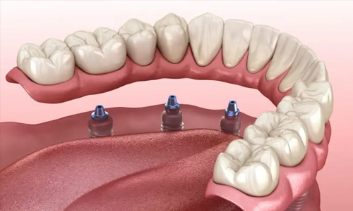 Dental implant diagram showing three titanium posts embedded in jawbone with artificial teeth above.