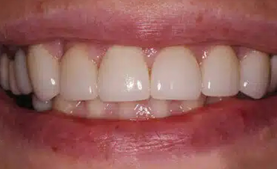 Close-up of upper front teeth showing dental work with natural appearance and proper alignment.