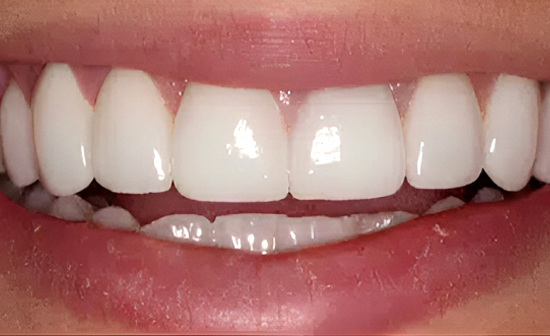 Close-up of bright white teeth and smile showcasing professional dental work and oral health