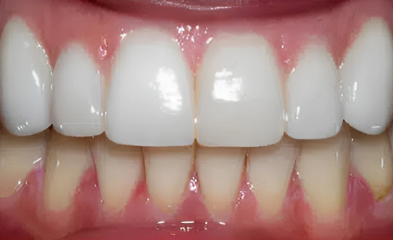 Close-up of upper front teeth showing white dental crowns and natural gum tissue in clinical setting.