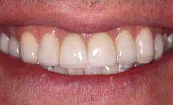 Close-up of a healthy smile showing white, evenly-spaced front teeth and pink gums.
