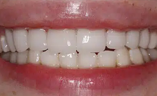 Close-up of teeth showing natural smile with visible spacing and alignment variations.