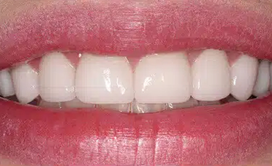 Close-up of a bright white smile showing healthy upper front teeth and pink lips.