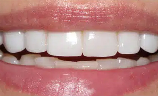 Close-up of a bright white smile showing healthy, well-aligned teeth and pink gums.