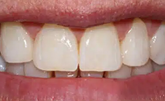 Close-up of upper front teeth showing dental work and natural tooth appearance in clinical setting.