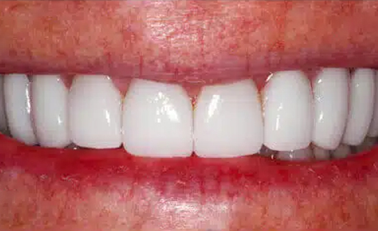 Close-up of bright white dental veneers or crowns displayed on natural gum tissue.