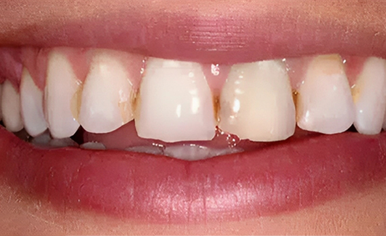 Close-up of upper front teeth showing slight gap between central incisors and natural tooth coloration.