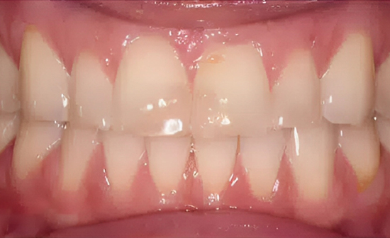 Close-up view of healthy white teeth and pink gums in a dental setting.