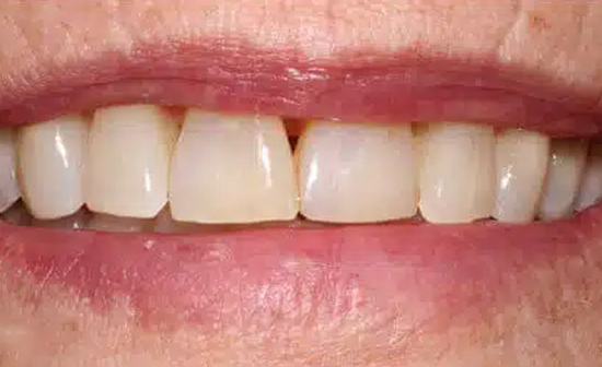 Close-up of upper front teeth showing dental work and natural smile for dental practice.