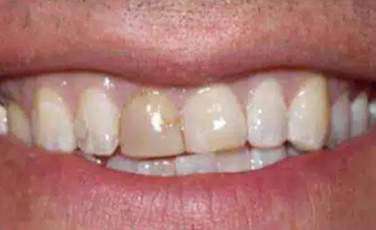 Close-up of teeth showing discoloration and spacing issues before dental treatment.