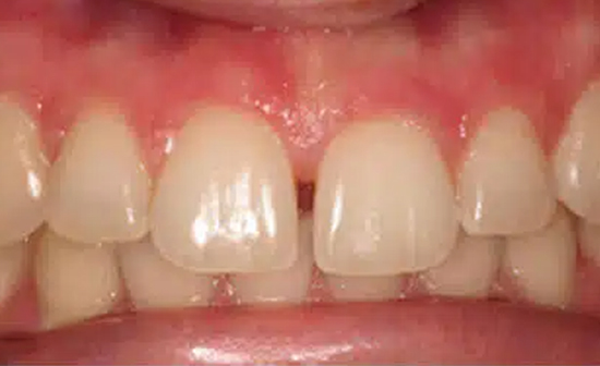 Close-up of upper front teeth showing natural dental alignment and white tooth coloring in clinical setting.