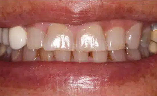 Close-up of upper front teeth showing dental work and gum health examination.