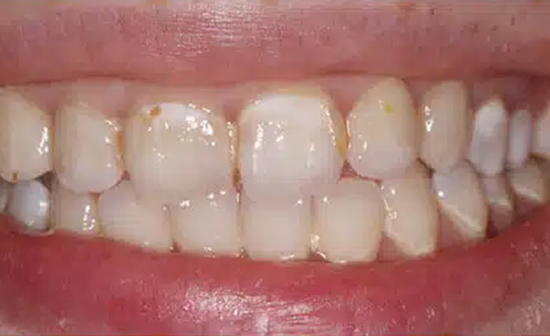 Close-up of healthy human teeth and gums showing natural dental appearance and oral health.