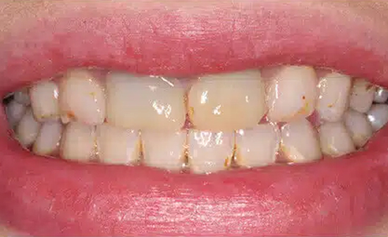 Close-up of human smile showing upper and lower teeth with visible discoloration and spacing irregularities.