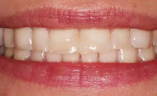 Close-up view of healthy upper teeth and smile showing dental work results.