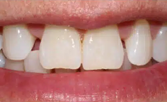 Close-up of upper front teeth showing white dental crowns and natural tooth structure.