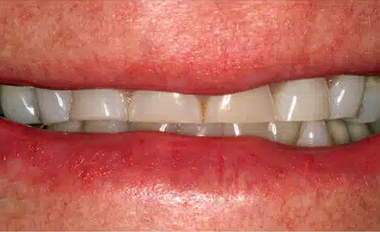 Close-up of upper and lower teeth showing dental alignment and bite assessment.