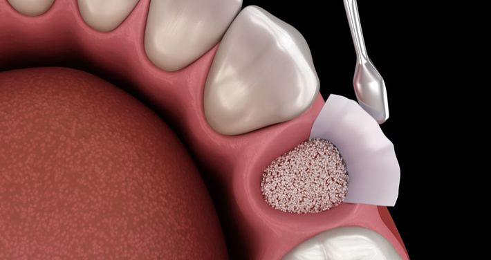 Dental implant cross-section showing tooth structure and bone integration against dark background.