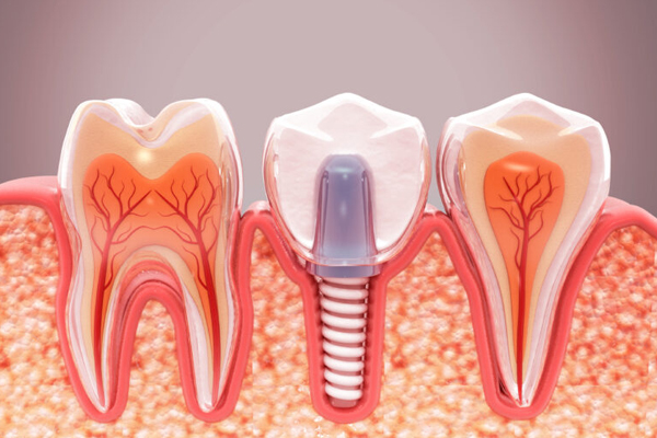 Dental implant diagram showing cross-section of tooth structure with artificial implant between natural teeth.