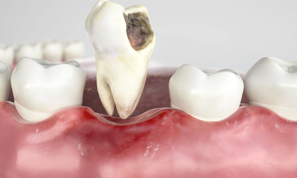 Dental diagram showing tooth decay and extraction procedure with gum tissue model.