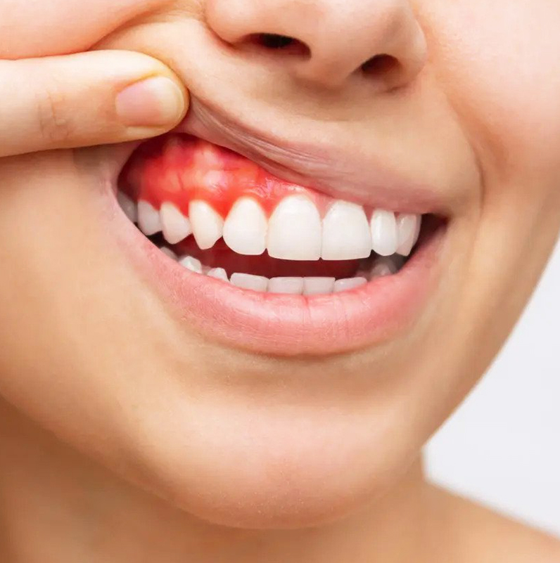 Person pointing to inflamed red gum area on upper tooth, demonstrating gum disease or dental health problem.