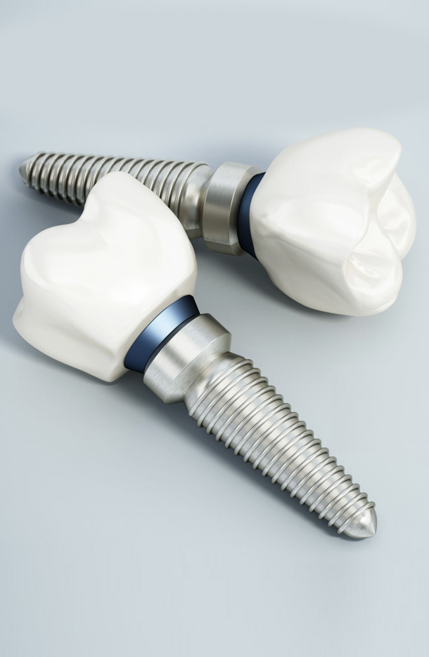 Three dental implants with white crowns and metal screws displayed on light background.