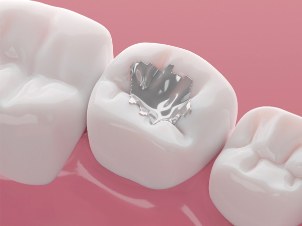 White tooth with dental filling against pink background, showing restorative dentistry treatment.