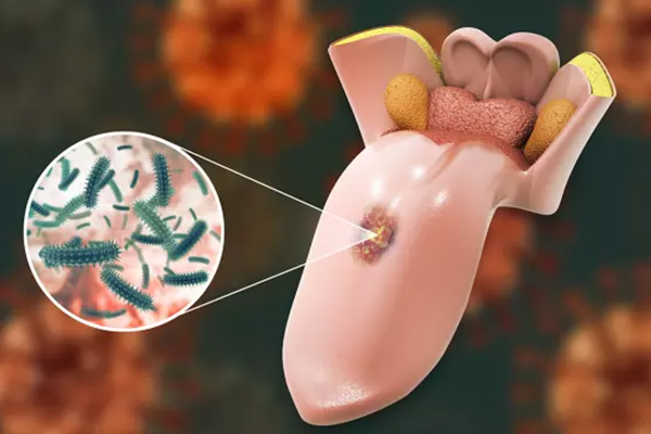 Animated tooth-shaped structure with magnified bacterial microorganisms displayed against blurred orange background.