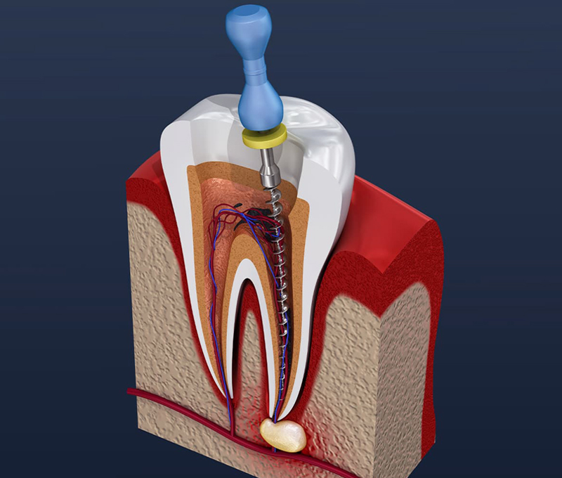 3D dental diagram showing root canal treatment procedure with cross-section of tooth anatomy.