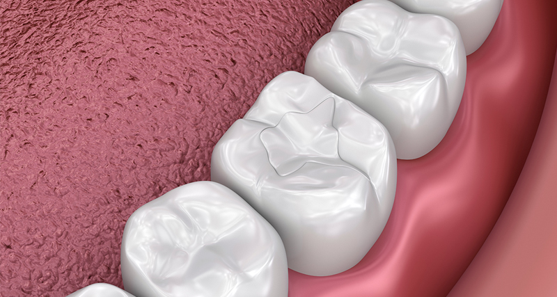 Three white dental crowns displayed on pink gum model showing restorative dental work.